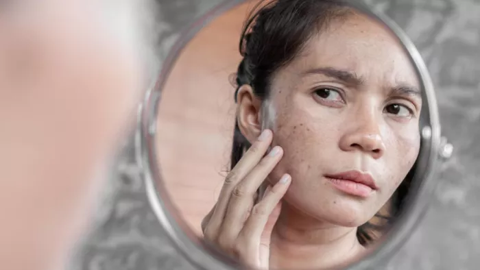 HyperPigmentation से बचने के लिए अपनाएं ये टिप्स (Picture Credit- Freepik)