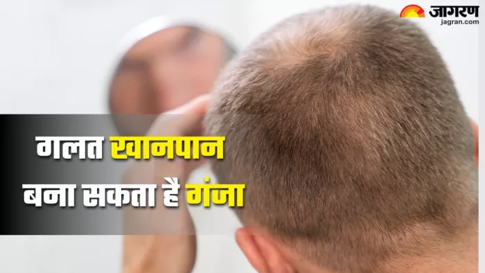 खानपान की गलत आदतें बनती हैं गंजेपन का कारण (Picture Credit- Freepik)