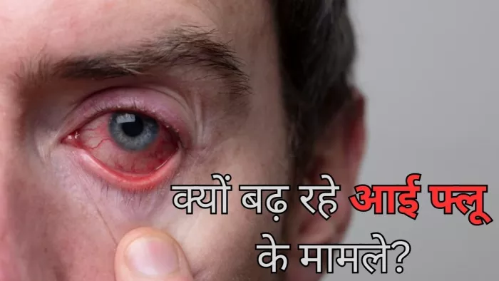 अचानक क्यों बढ़ रहे आई फ्लू के मामले, एक्सपर्ट से जानें वजह