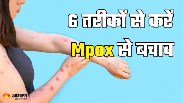 इन तरीकों से करें एमपॉक्स से बचाव (Picture Credit- Freepik)