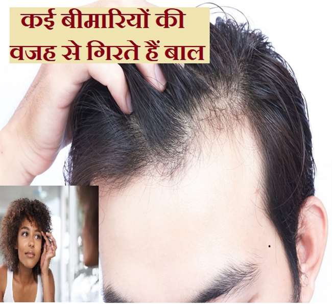 Causes of Hair Loss: सिर और आइब्रो के बाल बॉडी में इन 5 बीमारियों के पनपने  से गिर सकते हैं - are you worried about hair falling know the 5 Reasons for