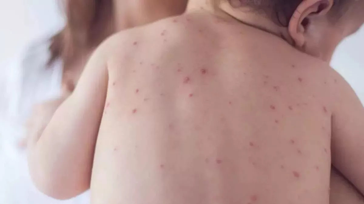 Measles Virus: भारत में खसरा ने पसारे पैर (फाइल फोटो)