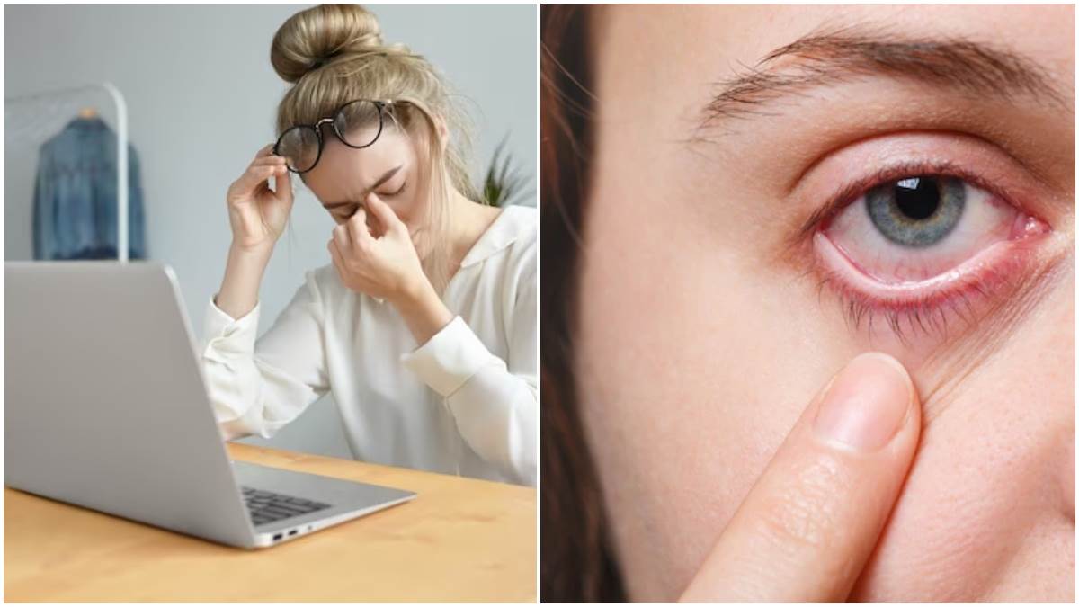 Eye Irritation Remedy आंखों में हो रही है जलन और खुजली तो अपनाएं घरेलू