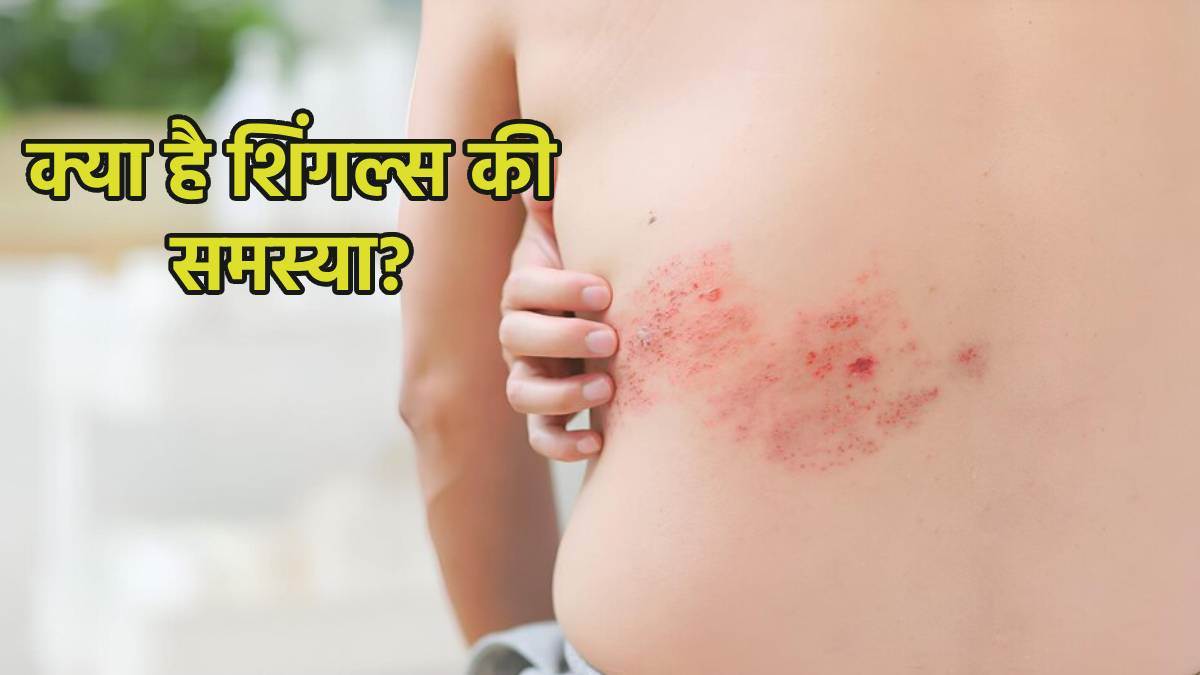 https://www.jagranimages.com/images/newimg/29022024/29_02_2024-shingles_disease_23663994.jpg