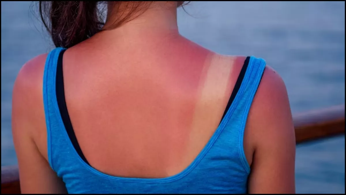 Sunburn Remedies: चिलचिलाती धूप ने झुलसा दी है आपकी त्वचा, तो इन 2 घरेलू नुस्खों से वापस पाएं खोया हुआ निखार