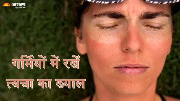 गर्मियों में ऐसे करें Sunburn और Sun Poisoning से बचाव (Picture Credit- Freepik)