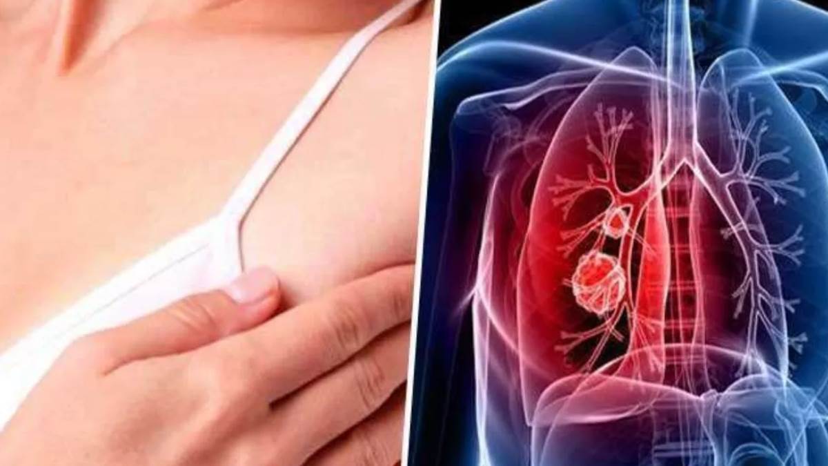 https://www.jagranimages.com/images/newimg/29062025/29_06_2025-lung_cancer_23971010.jpg
