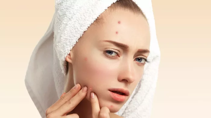 Home Remedies for Pimples: पिंपल दूर करने का कारगर घरेलू पैक