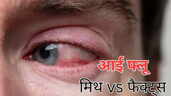 आई फ्लू से जुड़े वो मिथ, जो आपको जानना जरूरी है