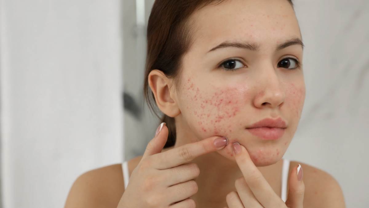 फोड़े जैसे दर्द भरे मुहांसे बन गए हैं खूबसूरती के दुश्मन? ये Pimples Cream कुछ ही दिनों में दिखाएगी अच्छे रिजल्ट