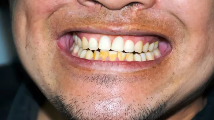 Teeth Whitening Tips: दांतों का पीलापन दूर करने के उपाय