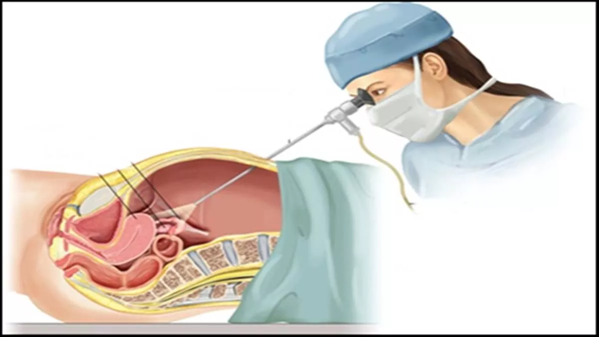 Laparoscopic Surgery: दूरबीन से सर्जरी करवाना बेहद सुरक्षित, इंफेक्‍शन का नहीं होता खतरा; रिकवरी भी जल्‍द