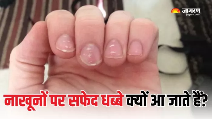 इस पोषक तत्व की कमी से नाखून पर हो जाते हैं सफेद दाग (Picture Courtesy: Freepik)