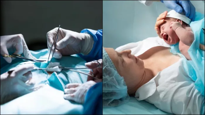 सी-सेक्शन डिलेवरी से जुड़े 5 आम मिथक