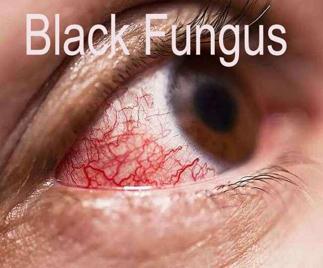 Black Fungus Symptoms and Treatment समय पर उपचार होने से आंखों की रोशनी बचाई जा सकती है।