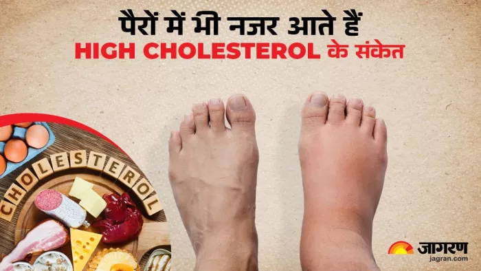 पैरों में दिखने वाले ये लक्षण कोलेस्ट्रॉल बढ़ने की ओर इशारा करते हैं।