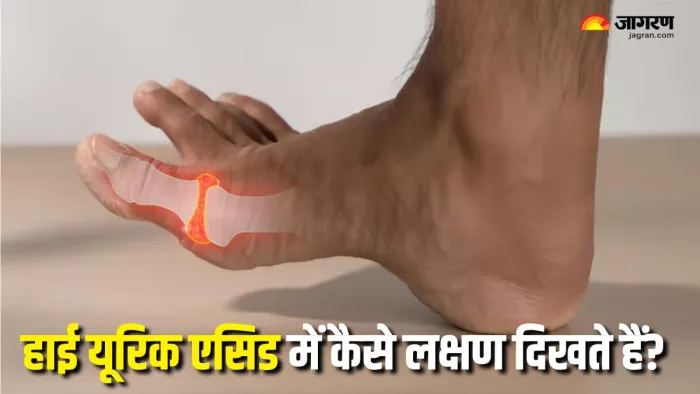 High Uric Acid के लक्षण कैसे होते हैं? (Picture Courtesy: Freepik)