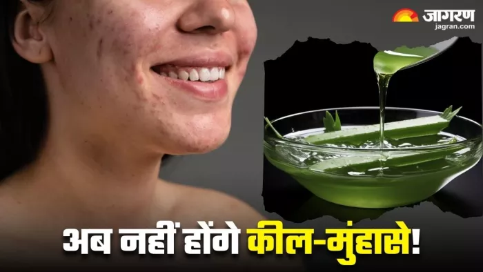 कील-मुंहासों से छुटकारा दिलाएंगी ये 4 नेचुरल चीजें (Image Source: Freepik)