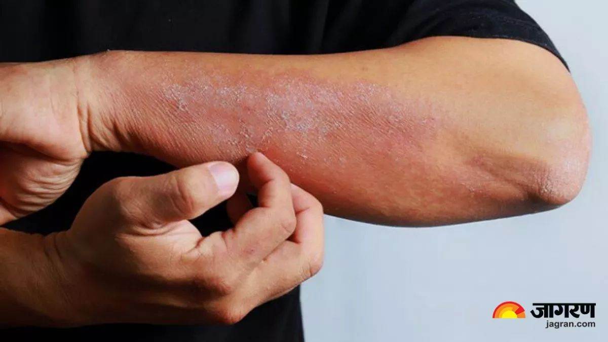https://www.jagranimages.com/images/newimg/30072025/30_07_2025-fungal_infection_23998706.jpg