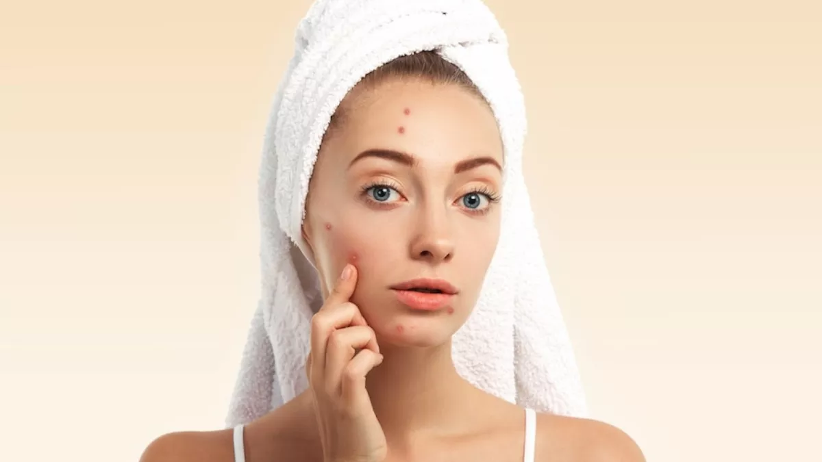 Acne Problem Solution: डेयरी प्रोडक्ट्स भी बन सकते हैं मुंहासों की वजह, इन उपायों से पाएं छुटकारा