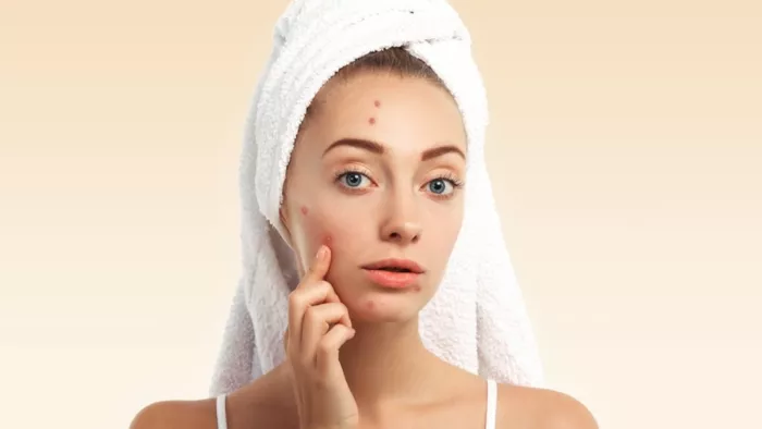Acne Problem Solution: मुंहासे दूर करने के आजमाएं ये उपाय
