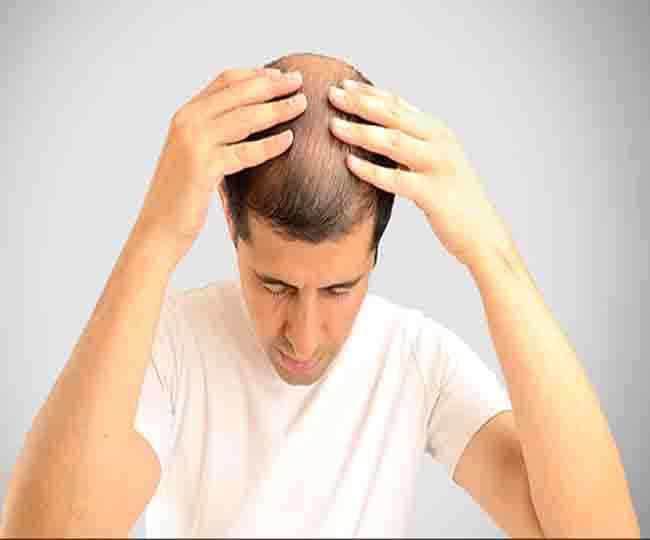 Hair Care Tips : अगर गंजा हो रहे हैं तो यह करें 5 उपाय, जल्द मिल जाएगी  मुक्ति - Hair Care Tips : If you are going bald then do these 5 measures in  Hindi