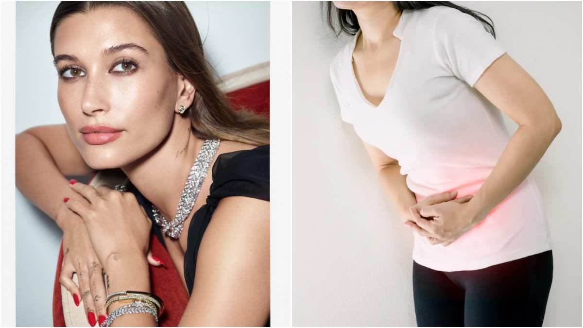 supermodel hailey bieber has an apple size ovarian cyst know its symptoms