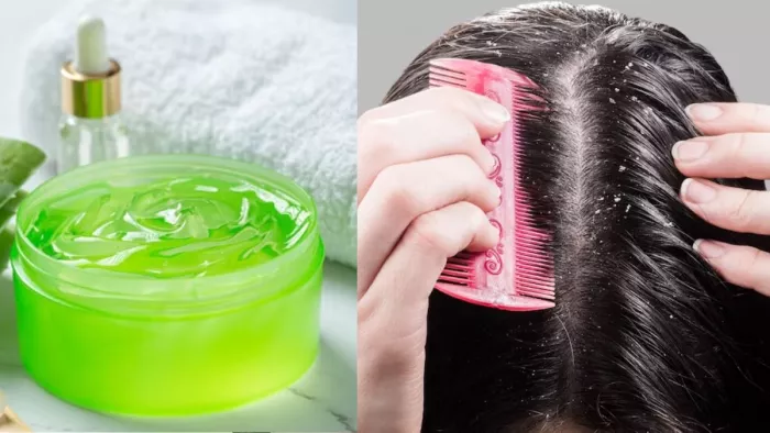 Hair Care Tips: ड्रैंड्रफ की करना चाहते हैं छुट्टी, तो इन तरीकों से करें एलोवेरा जेल का इस्तेमाल