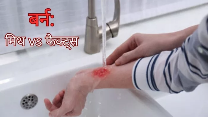 क्या आप भी करते हैं जलने से जुड़े इन मिथकों पर यकीन