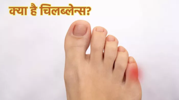 चिलब्लेन्स के कारण लक्षण उपचार और बचाव