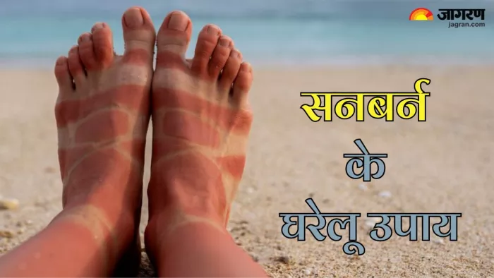 इन तरीकों से पाए सनबर्न से राहत (Picture Credit- Freepik)