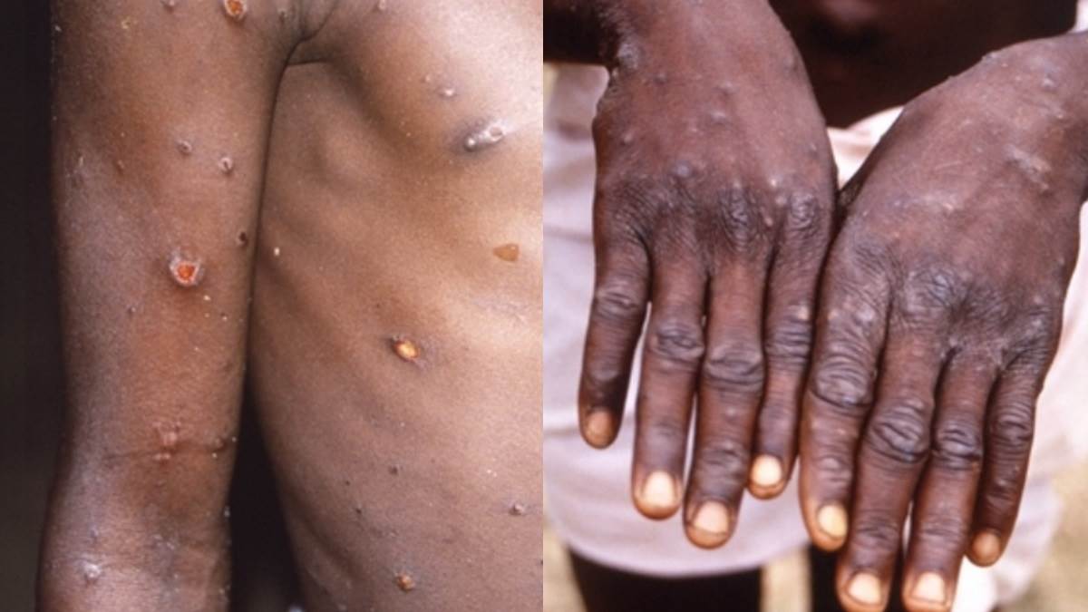 monkeypox vs chickenpox: मंकीपॉक्स और चिकनपॉक्स में क्‍या अंतर है जानें क्‍या है विशेषज्ञों की राय...