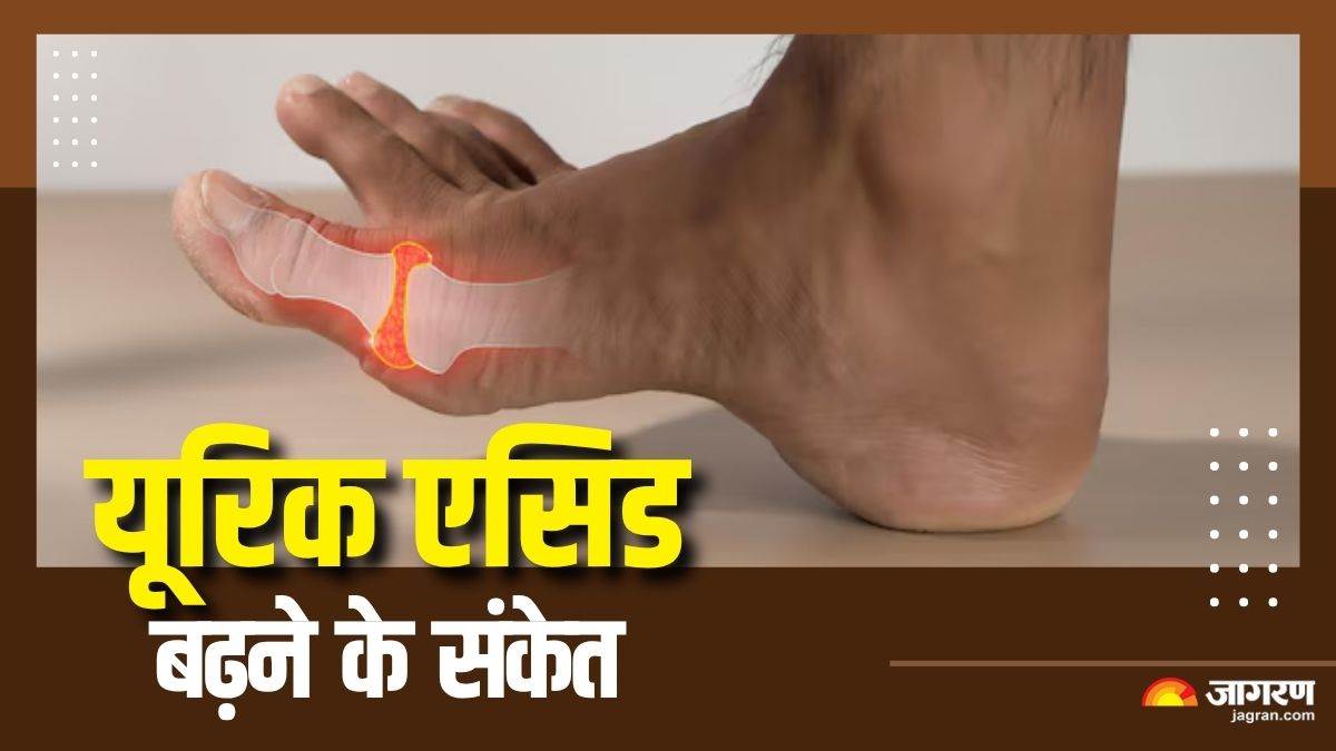 https://www.jagranimages.com/images/newimg/31072025/31_07_2025-signs_of_high_uric_acid_23999422.jpg