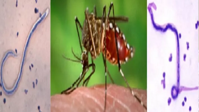 Filariasis Treatment: एक दिन में संभव है फाइलेरिया का इलाज