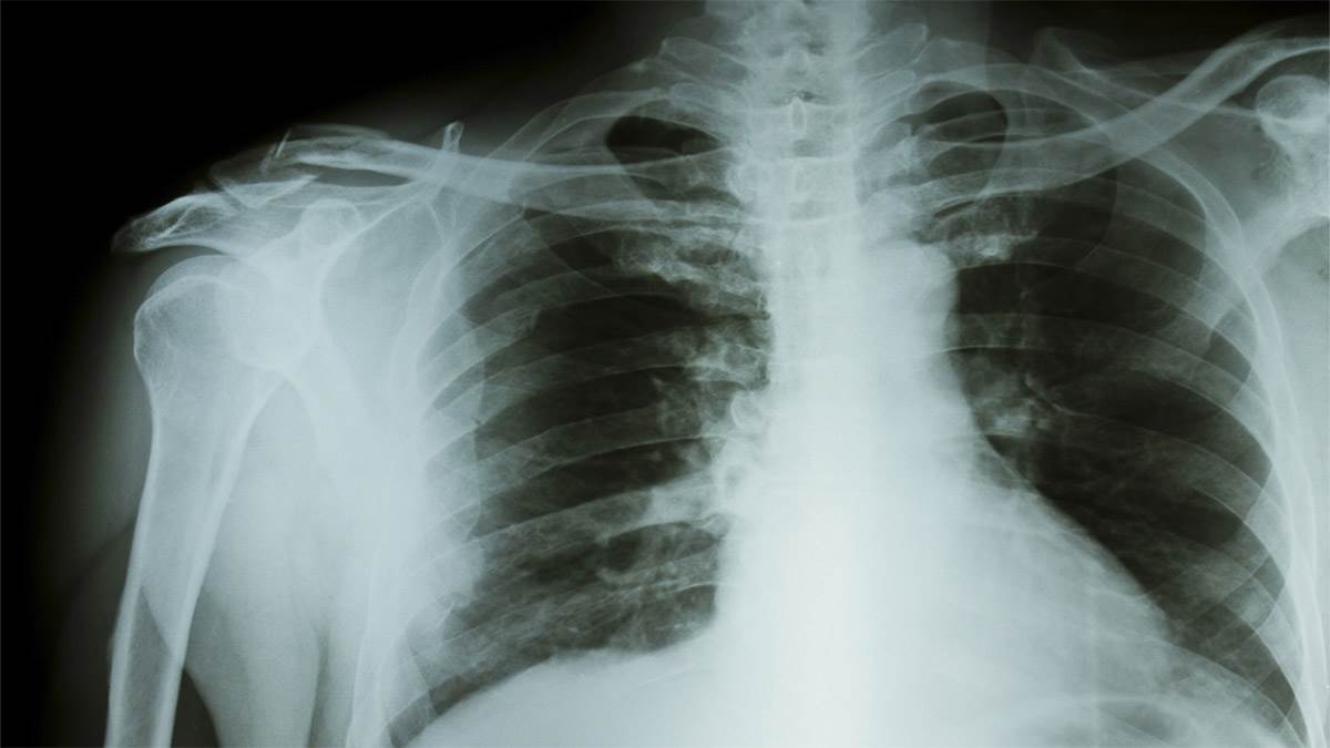 https://www.jagranimages.com/images/newimg/31102022/31_10_2022-tuberculosis_23172894.jpg