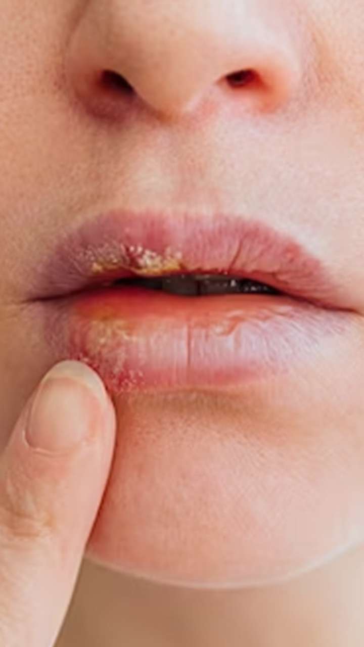 होंठों का बार-बार सूखना क्या संकेत देता है?